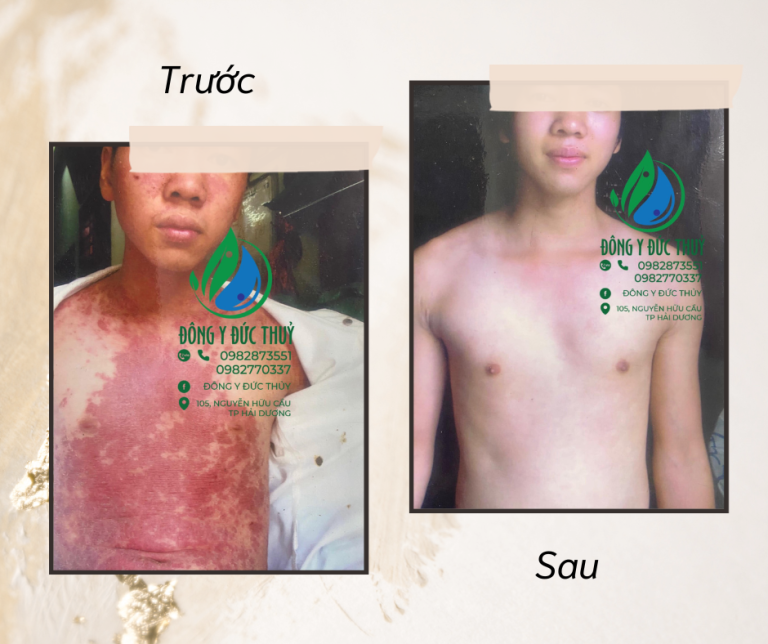 điều trị vảy nến bằng đông y ở Hải dương, phòng khám đông y Đức Thủy
