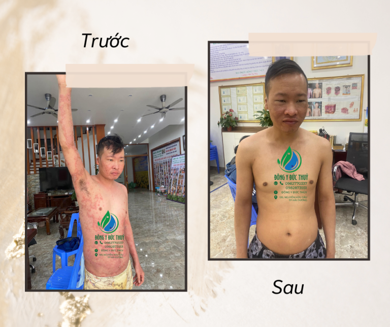 điều trị vảy nến bằng đông y ở Hải dương, phòng khám đông y Đức Thủy