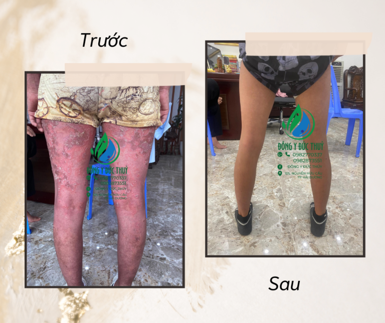 điều trị vảy nến bằng đông y ở Hải dương, phòng khám đông y Đức Thủy