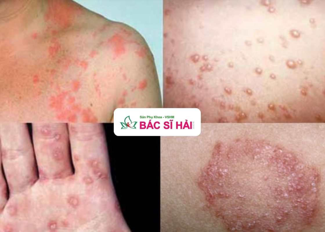 chữa bệnh giang mai ở hải dương