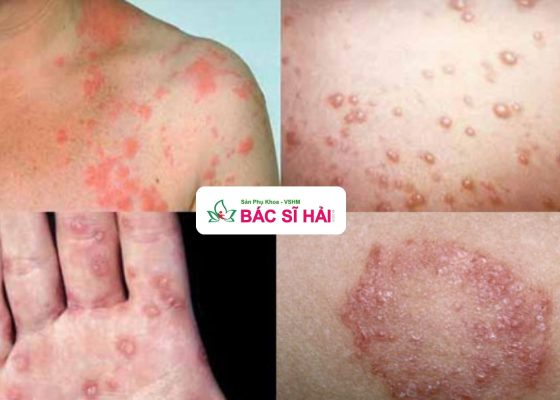 chữa bệnh giang mai ở hải dương